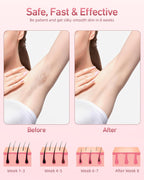 IPL Hair Removal Device – Intense Pulsed Light Technology